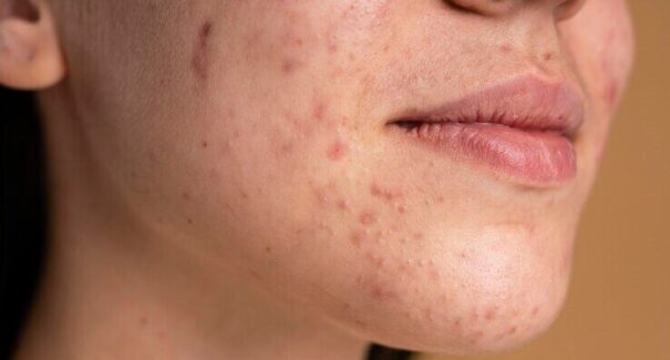 Chocolate causa acne e espinhas? Especialista esclarece