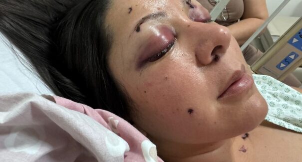 Enfermeira maranhense sobrevive a tiro no rosto dado pelo ex-companheiro e transforma trauma em luta contra violência