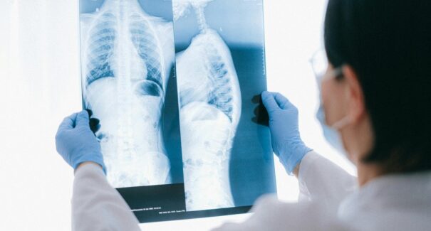 Tuberculose avança no Maranhão e especialistas alertam para “ameaça silenciosa”